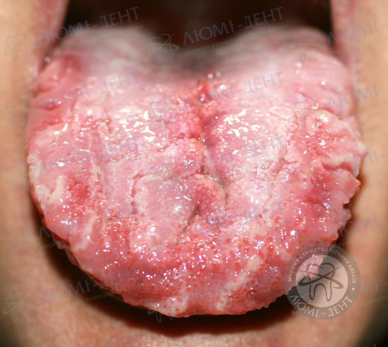 Стоматит во рту у взрослых Как лечить стоматит на губе, языке